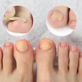 Kit de 100 Patchs Correcteurs pour Ongle Incarné