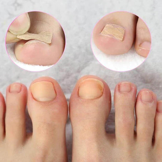 Kit de 100 Patchs Correcteurs pour Ongle Incarné