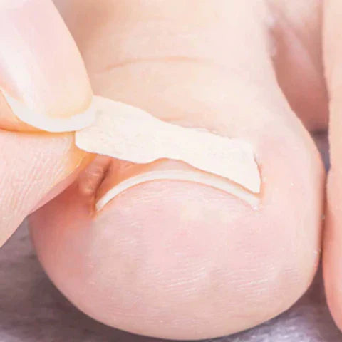 Kit de 100 Patchs Correcteurs pour Ongle Incarné
